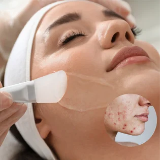 Chemical Peels: Acne Treatment Focus